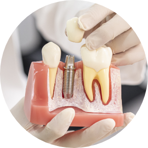 Mir Implant System image3